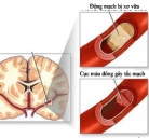 Phòng ngừa tai biến mạch não khi trời lạnh