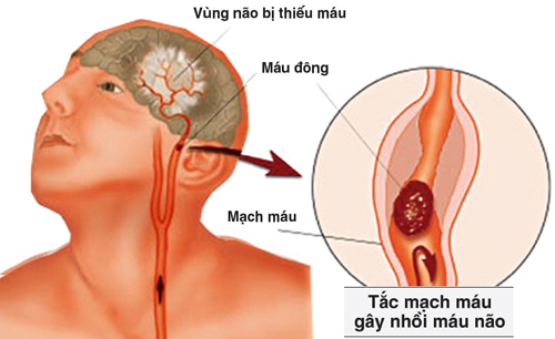 Tác hại tim mạch do đái tháo đường (phần 1)