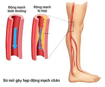 Bệnh động mạch chi dưới ở người cao tuổi dễ nặng lên vào mùa lạnh