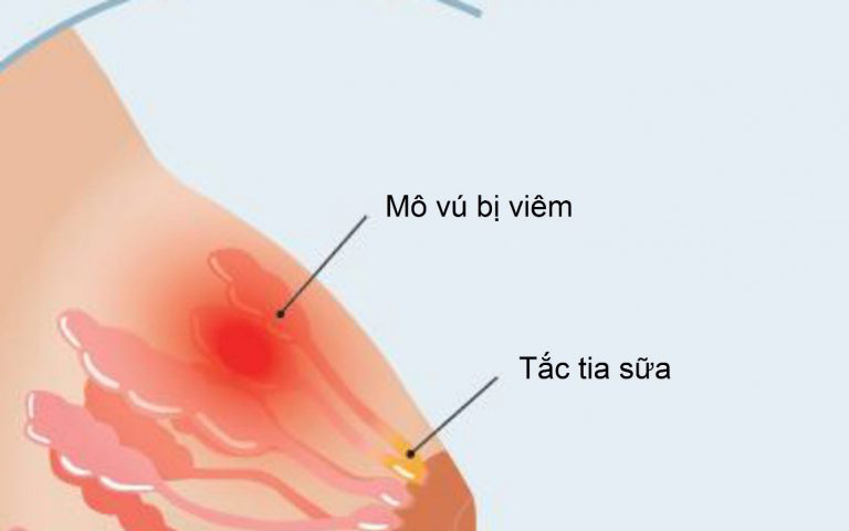 3 vị thuốc dễ kiếm chữa tắc tia sữa tại nhà