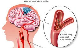 Bệnh xơ vữa động mạch não