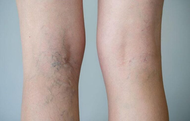 8 điều cần biết về suy tĩnh mạch chân